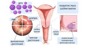 Прививка от рака шейки матки: до какого возраста, отзывы специалистов