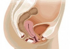 Опущение матки после родов: симптомы и лечение