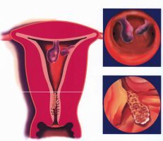 Железисто-фиброзный полип эндометрия: что это такое, лечение после удаления