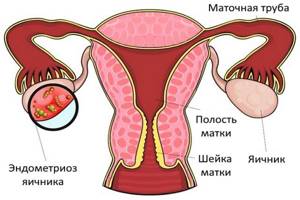 Эндометриоз яичника: симптомы и лечение