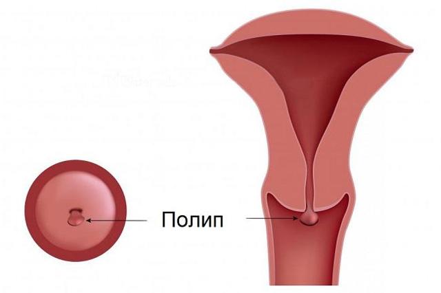 Гиперплазия эндометрия в менопаузе: симптомы, лечение