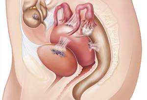 Эндометриоз шейки матки: симптомы и лечение, фото