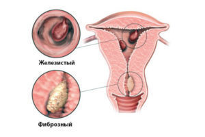 Децидуальный полип при беременности