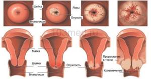 Рак шейки матки: симптомы и признаки, сколько живут, лечение