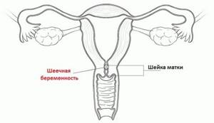 Почему не растет эндометрий: причины недоразвитости слизистого слоя матки