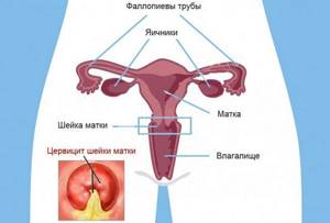 Воспаление шейки матки: причины, симптомы и лечение