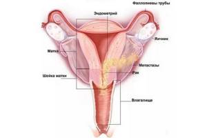 Рак матки: первые признаки и симптомы у женщин, сколько живут после операции