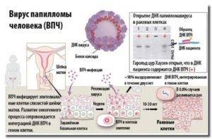 Прививка от рака шейки матки: до какого возраста, отзывы специалистов