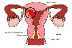 Как проходят месячные при эндометриозе