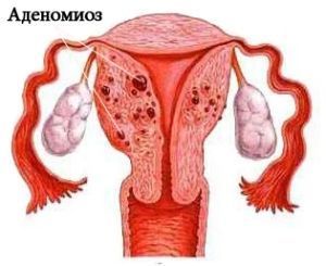 Аденомиоз матки: что это такое и как лечить