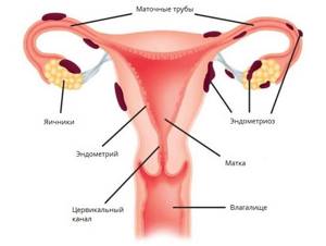 СА-125: норма у женщин при эндометриозе