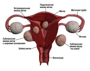 Миома шейки матки: симптомы и лечение, допустимые размеры
