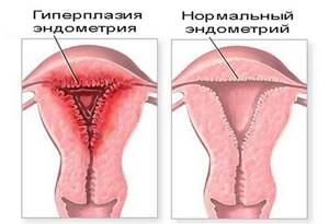 Гиперпластический процесс эндометрия: что это такое