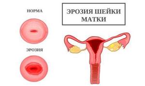 Биопсия шейки матки при эрозии: как проводится, результаты, отзывы