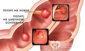 Аденоматозный полип эндометрия: причины, симптомы, лечение