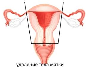 Операция при выпадении матки: сравнение популярных методов