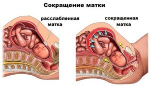 Тонус матки при беременности: симптомы в 1, 2, 3 триместре