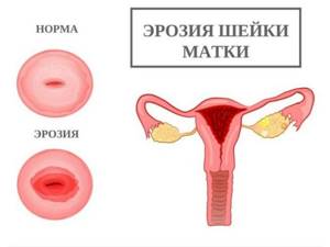 Эрозия шейки матки: причины появления у нерожавших и после родов