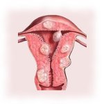 Диагностическое выскабливание полости матки при миоме: отзывы пациенток