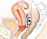 Ретроцервикальный эндометриоз: что это такое, симптомы и лечение
