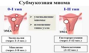 Субмукозная миома матки: что это такое, размеры для операции, лечение