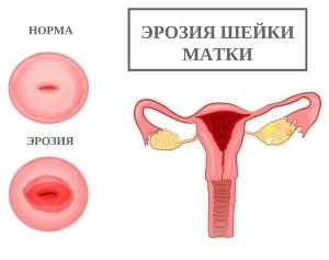 Эрозия шейки матки: лечение у нерожавших женщин