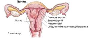 Рак матки: первые признаки и симптомы у женщин, сколько живут после операции