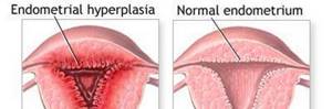 Норколут при гиперплазии эндометрия: инструкция по применению, отзывы