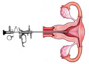 Гистерорезектоскопия полипа эндометрия: что это такое, послеоперационный период