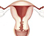 Эндометриоз шейки матки: симптомы и лечение, фото