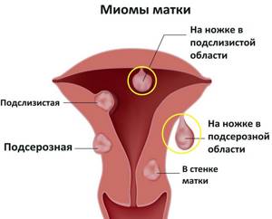 Диагностическое выскабливание полости матки при миоме: отзывы пациенток