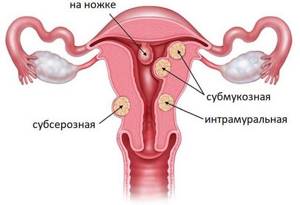 Субсерозная миома матки: что это такое, размеры для операции