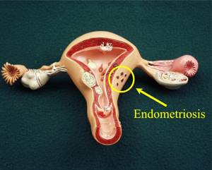 Эндометрия матки: что это такое доступным языком
