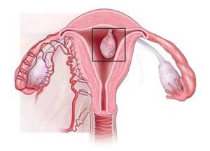 Полип эндометрия в матке: что это такое и как лечить