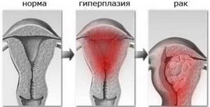 Гиперплазия эндометрия в менопаузе: симптомы, лечение