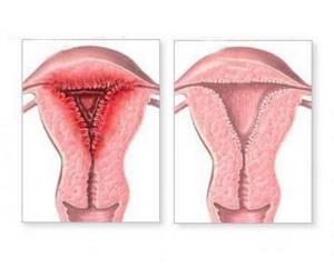 Эндометрит: симптомы и лечение у женщин, препараты, формы