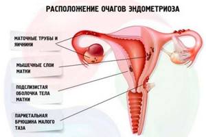Эко при эндометриозе: отзывы, шансы на оплодотворение