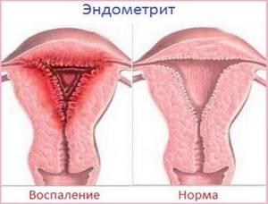 Эндометриоз у женщин после 40-50 лет: симптомы и лечение