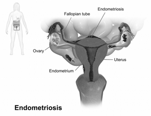 Боровая матка при эндометриозе: отзывы врачей