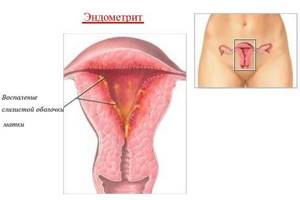 Эндометрит и беременность