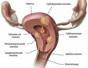 Субмукозная миома матки: что это такое, размеры для операции, лечение