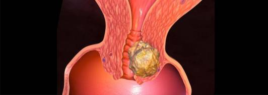 Рак шейки матки: симптомы и признаки, сколько живут, лечение