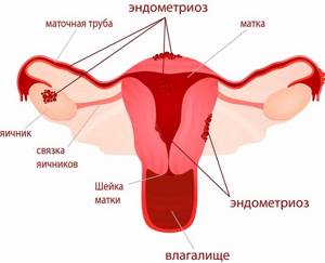 Что такое эндометриоз матки: симптомы и лечение у женщин, признаки, причины возникновения