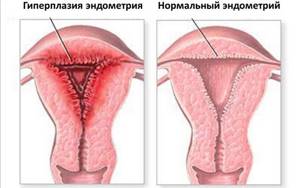 Атипическая (аденоматозная) гиперплазия эндометрия: что это такое