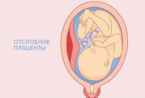 Полип и беременность: совместимы ли?