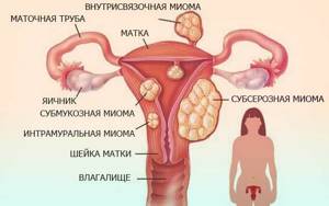 Физиотерапия при миоме матки: электрофорез, магнитотерапия