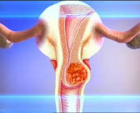 Рецидив рака шейки матки: причины, симптомы, лечение