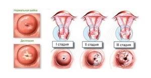 Воспаление шейки матки: причины, симптомы и лечение