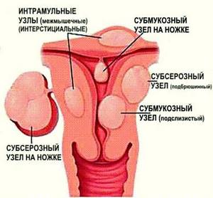Интерстициальная миома матки: что это такое, беременность, размеры