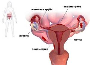 Боровая матка при эндометриозе: отзывы врачей